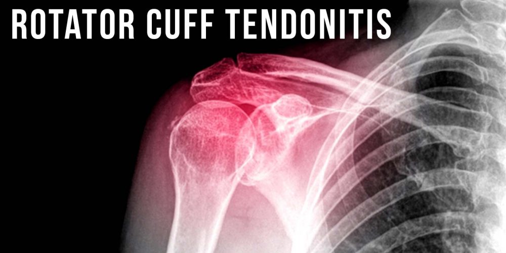 Your Self Series Rotator cuff tendonitis